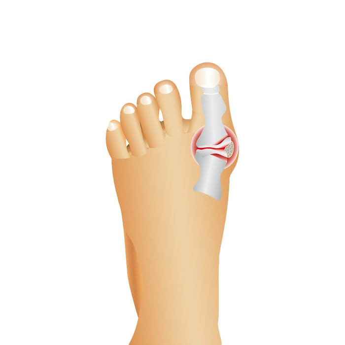 Corrector,de,juanetes,para,aliviar,y,tratar,el,dolor,de,Hallux,Valgus,BronHealt©,corrector,de,juanetes,hallux,valgus,corrector,de,juanetes,casero,juanetes,protector,de,juanetes,soluciones,hormonas,iridologia,kit,primeros,auxilios,asche,basis,salbe,fasciitis,plantar,fonendoscopio,french,manucure,grab,handles